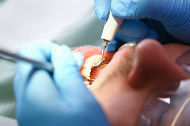 Best Emergency Dentist for Lost Fillings or Crowns in Boiling Springs, SC